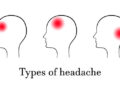 headache-diagram
