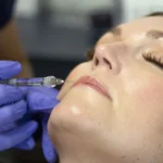 4 Aesthetic Treatments for Lines and Wrinkles