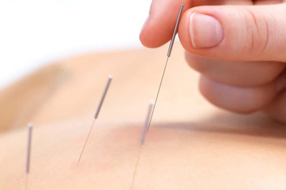 Understanding Brain Plasticity and the Role of Acupuncture