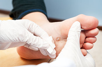 What You Need To Know About Treating Warts on Your Feet