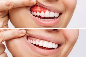 Why Periodontists Are the Experts in Treating Gum Disease and Inflammation