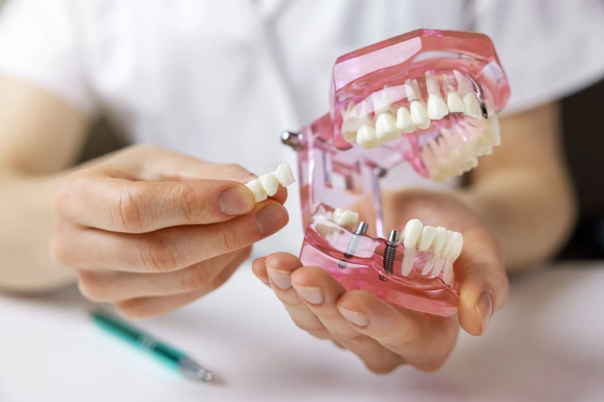 3 Signs You Need a Tooth Replacement