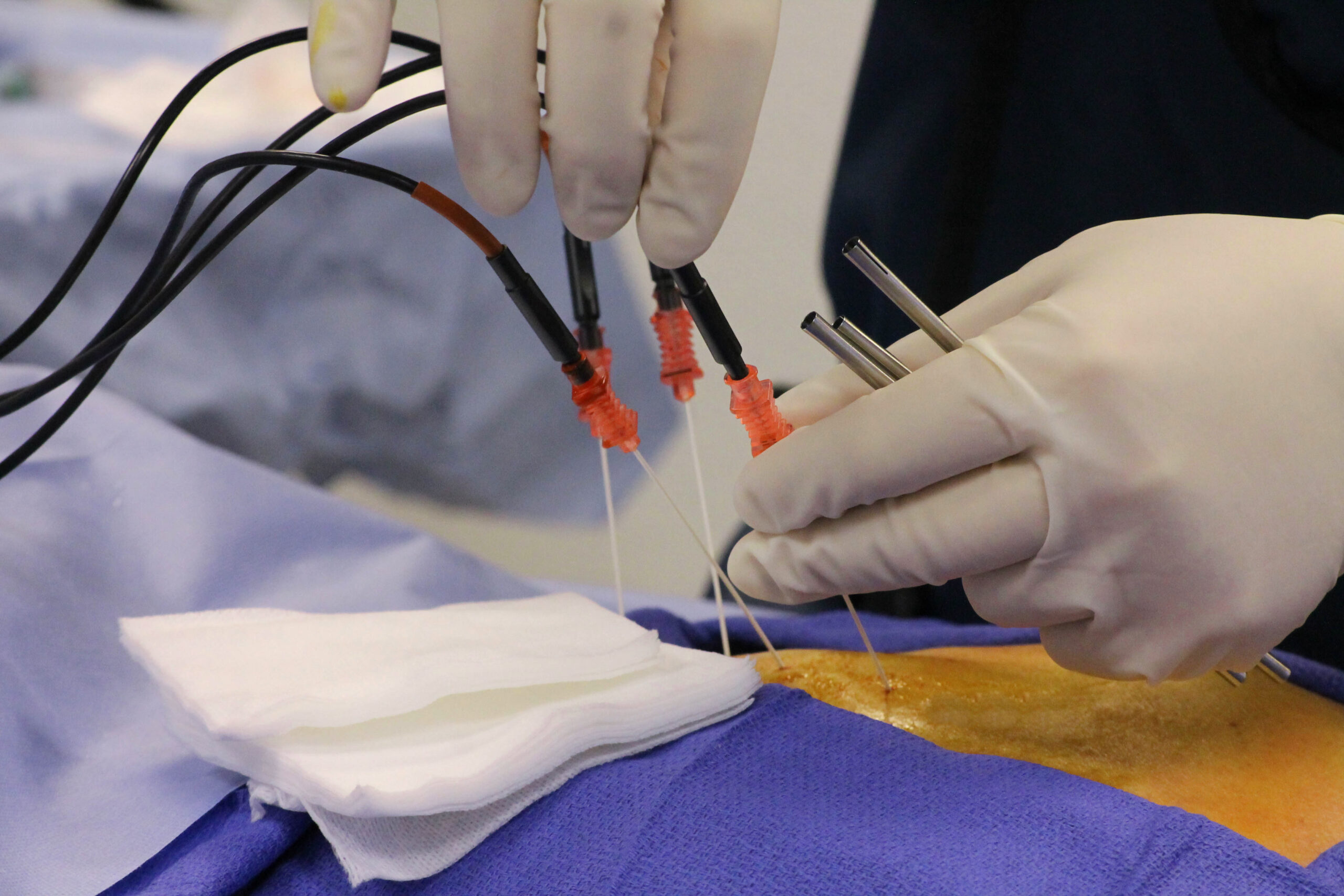 How Radio Frequency Ablation Works for Pain Relief