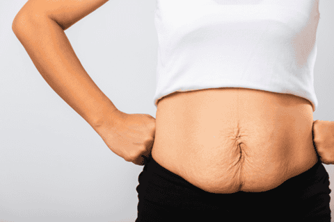 Pros and Cons of a Tummy Tuck