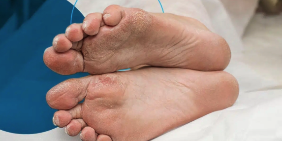 The Connection Between Diabetic Wound Care and Overall Health