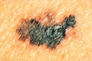 The Difference Between Non-Melanoma and Melanoma Skin Cancer