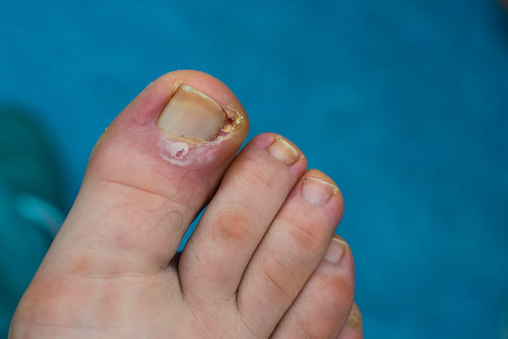 Understanding Potential Problems and Prevention Methods for Ingrown Toenails