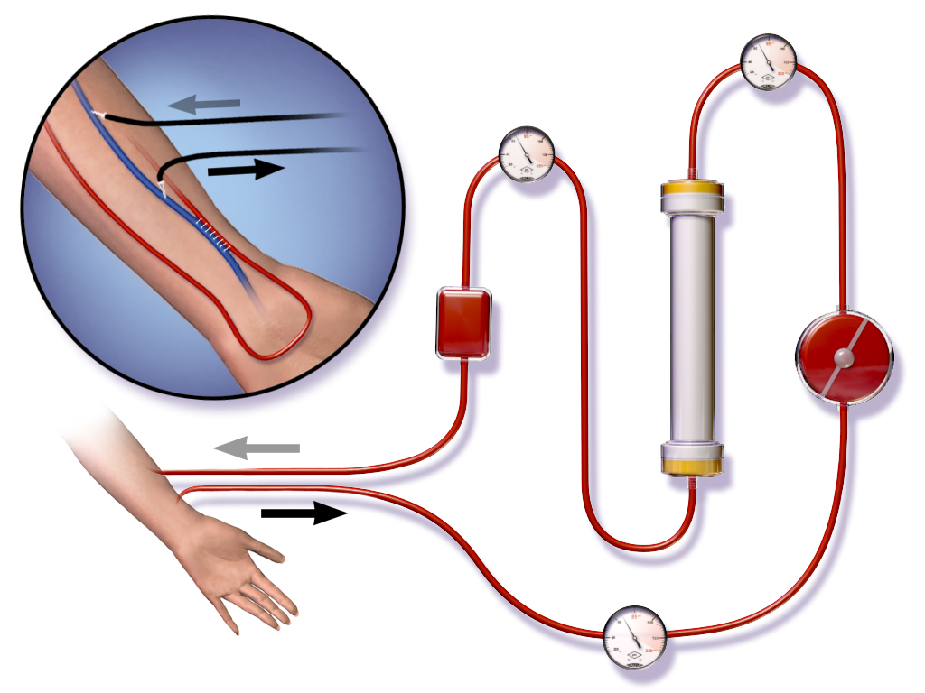Understanding the Lifesaving Benefits of Dialysis Access