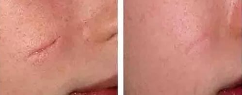 4 Wound Care Techniques to Reduce Scarring