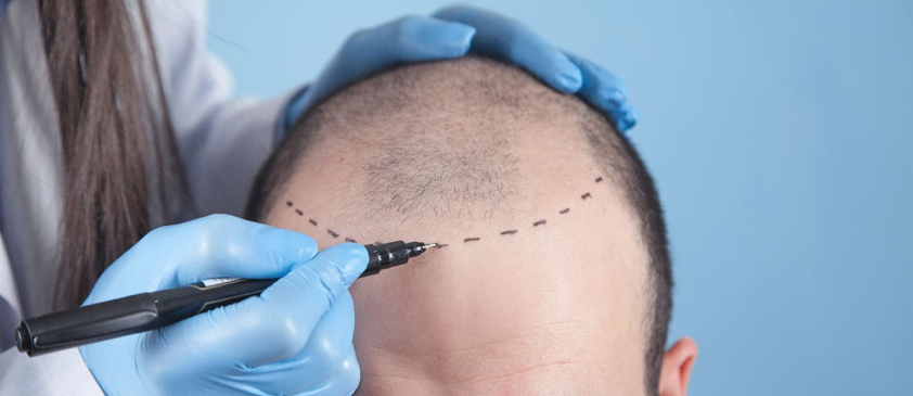 FAQ About Body Hair Transplants