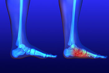 How Flat Feet Can Lead to Other Health Issues and How to Treat Them