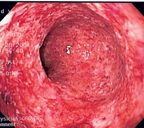 Signs and Symptoms of Ulcerative Colitis
