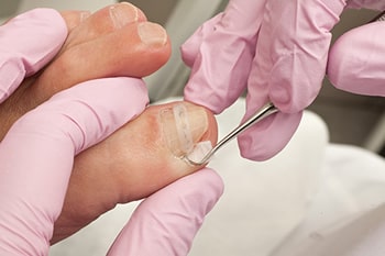 What are Ingrown Toenails?