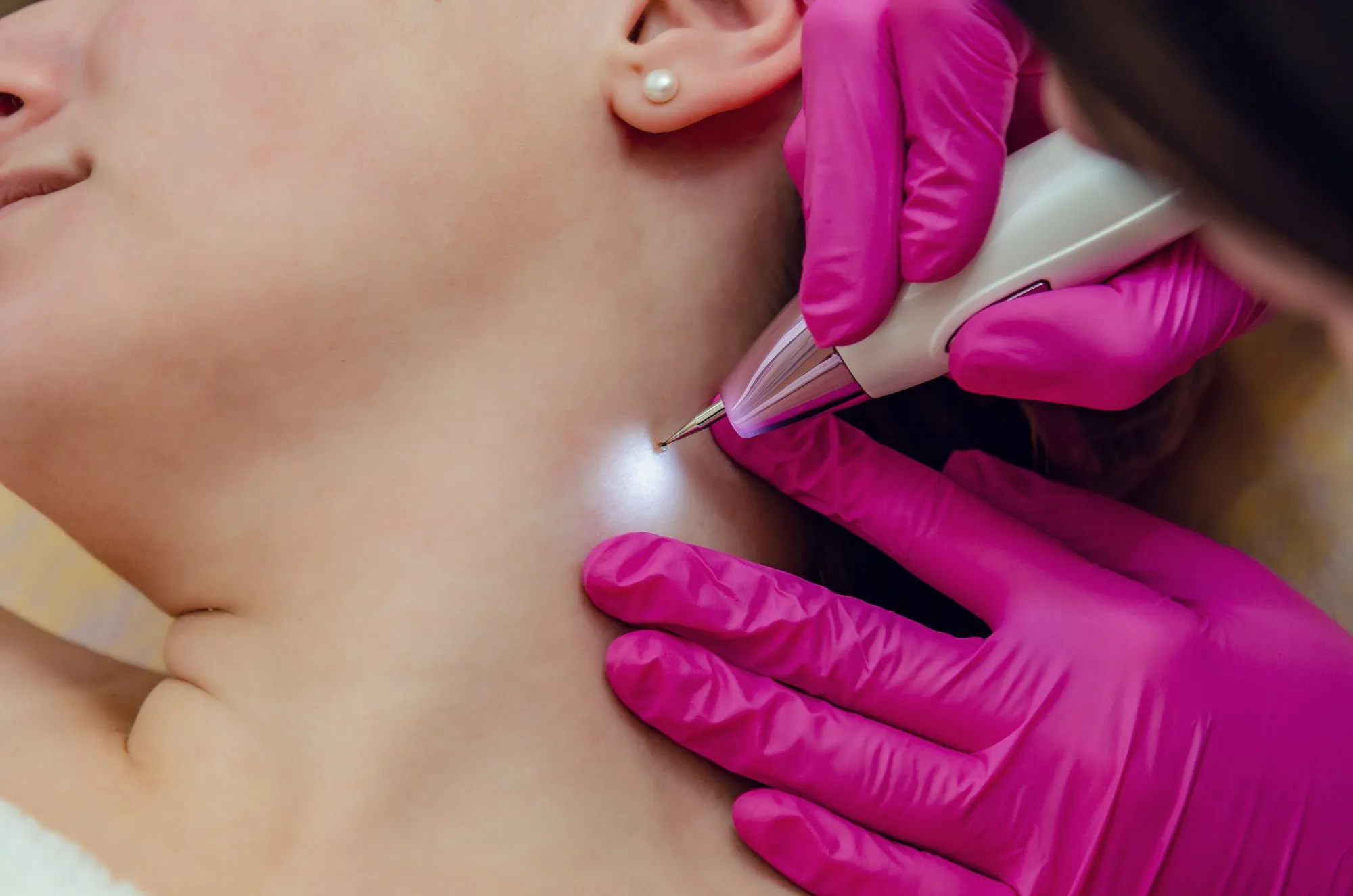 Methods and Aftercare of Skin Tag Removal