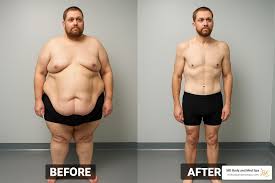 Weight Loss Surgery Options