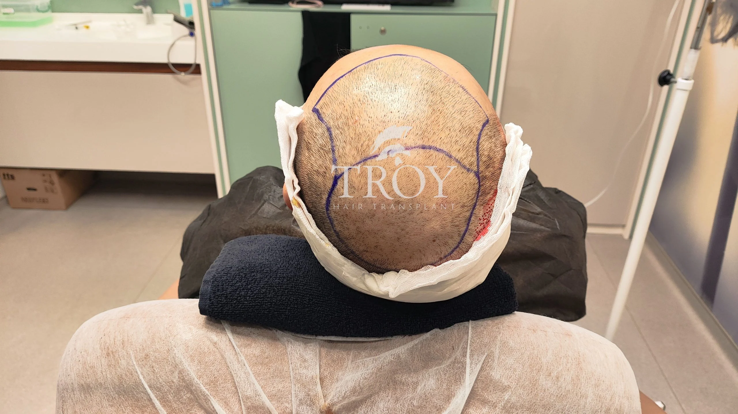 Realistic Expectations for What a Hair Transplant Can Achieve