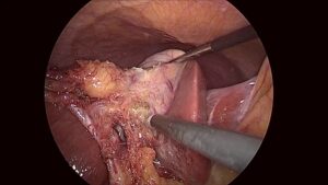 When To Get Gallbladder Surgery